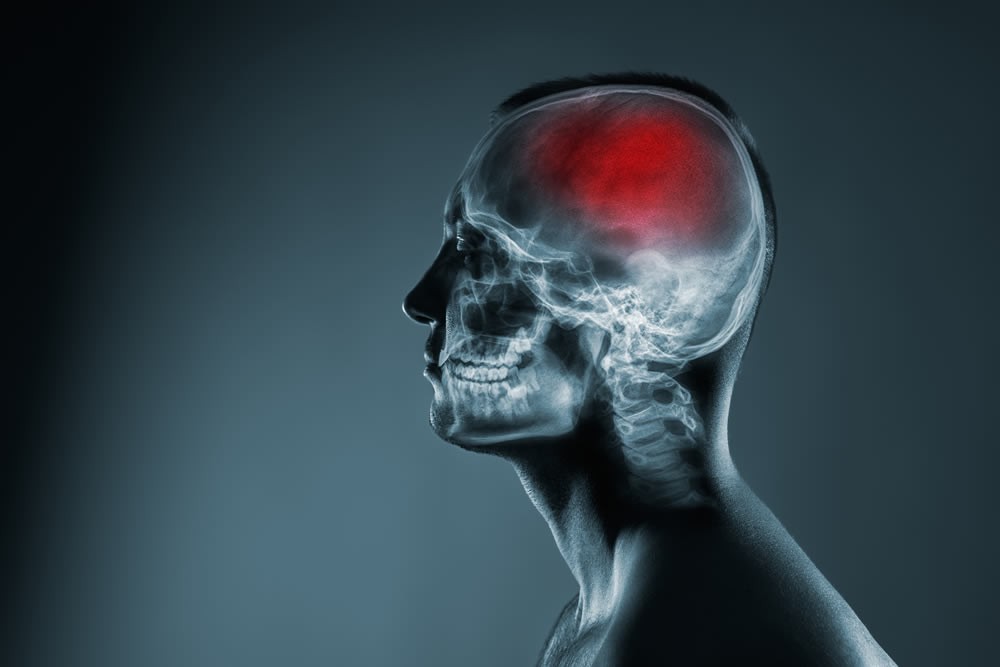 Traumatic Brain Injuries